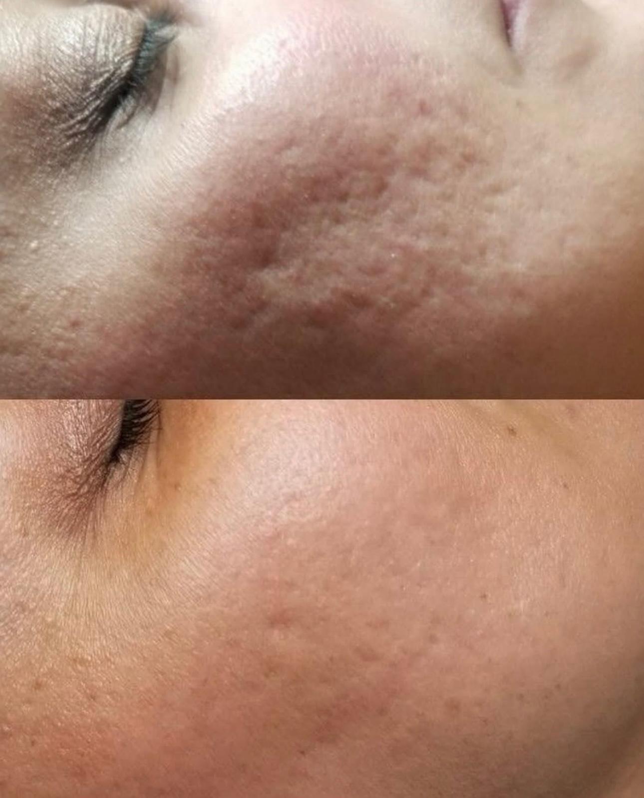 Résultats Microneedling acné avant après – Jasmine Skin Clinic