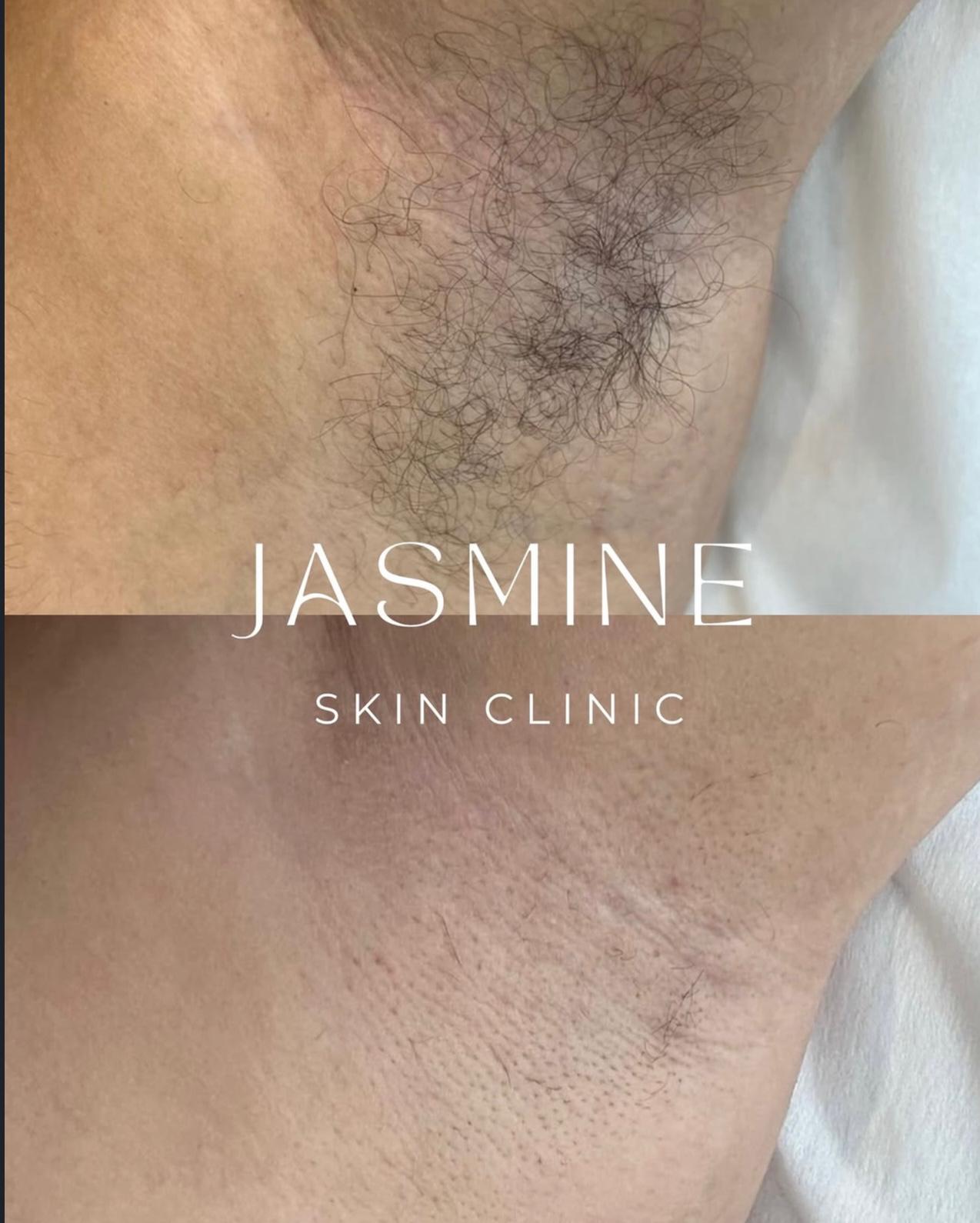 Épilation laser avant après – Jasmine Skin Clinic