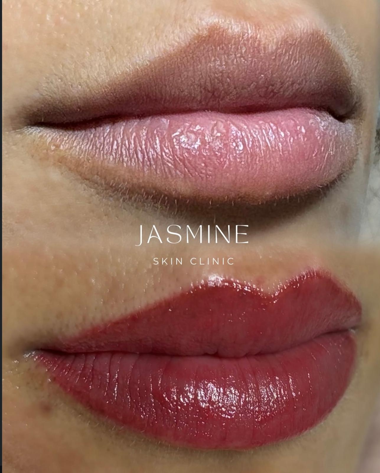 Glaçage lèvres avant après – Jasmine Skin Clinic