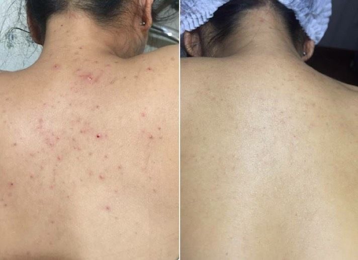 Avant après authentique d’un peeling dos Jasmine Skin
